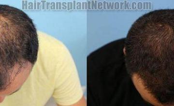 Top view - Before and after surgical hair replacement