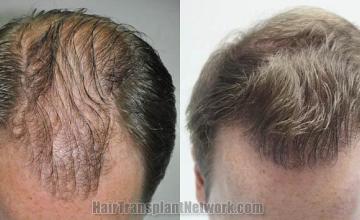 Top view before and after hair restoration results