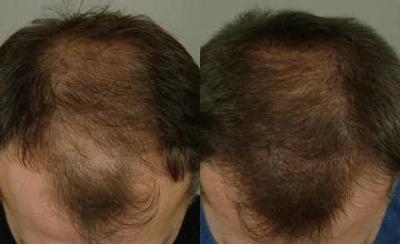 Hair transplantation surgery before and after images