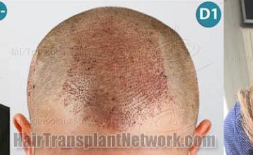 Hair transplantation surgery before and after images