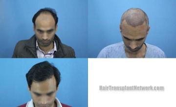 Before and after hair restoration procedure images