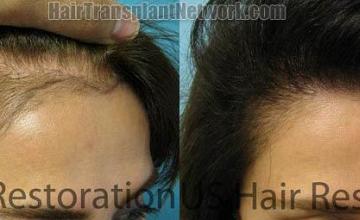 Hair restoration procedure before and after pictures