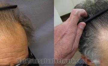 Hair transplantation surgery before and after images