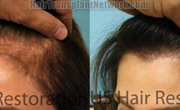 Surgical hair transplantation result photographs