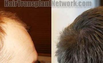 Hair transplantation surgery before and after photos