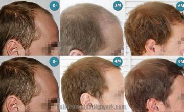 Hair transplantation surgery before and after photos