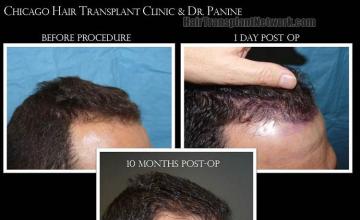 Hair transplantation surgery before and after images