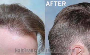 Hair transplantation surgery before and after photos