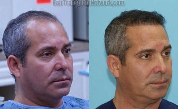 Hair transplantation surgery before and after images results