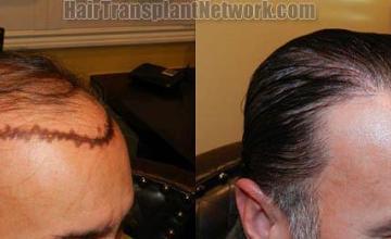 Hair transplantation surgery before and after images