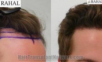 Hair restoration procedure before and after results