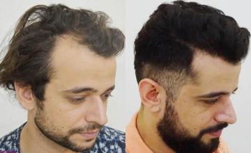 Hair transplantation procedure before and after results