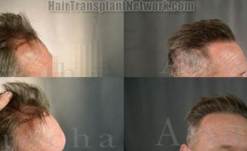 Hair transplantation procedure before and after results