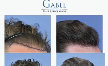 Hair transplantation procedure before and after results