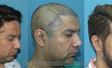 Hair transplantation procedure before and after results