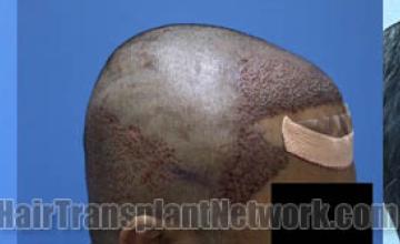 Hair restoration procedure before and after results