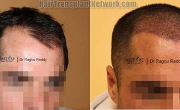 Hair transplantation surgery before and after images