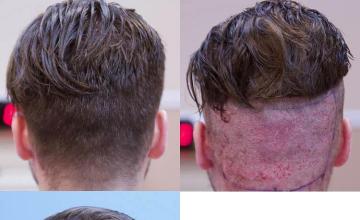 Surgical hair transplantation result photographs