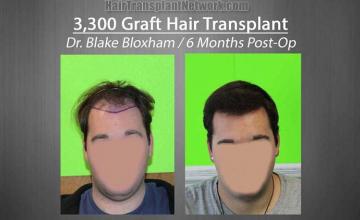 Hair restoration procedure before and after pictures