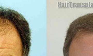 Front view - Before and after