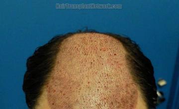 Hair restoration surgery before and after photos