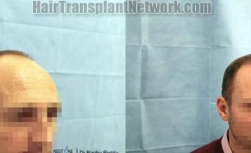 Hair transplantation surgery before and after images