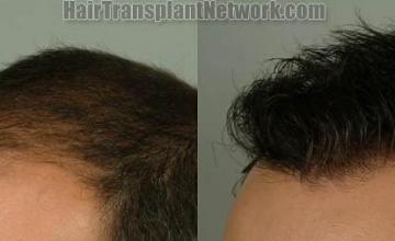 Hair transplantation surgery before and after images