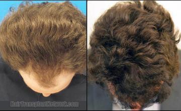 Top view before and after hair restoration results