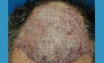 Surgical hair transplantation result photographs