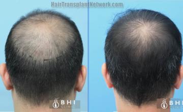 Surgical hair transplantation result photographs