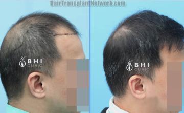 Hair restoration procedure before and after results