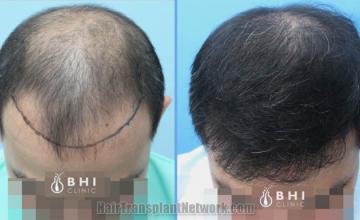 Hair restoration procedure before and after results