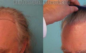 Hair transplantation surgery before and after pictures