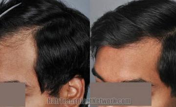 Hair transplantation surgery before and after images