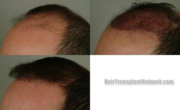 Hair transplantation surgery before and after photos