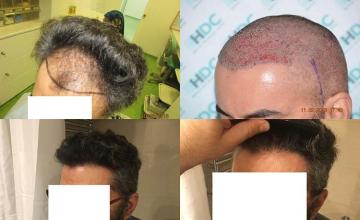 Hair restoration procedure before and after pictures