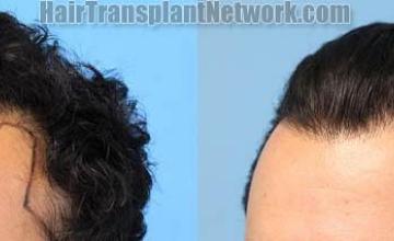 Hair restoration procedure before and after pictures