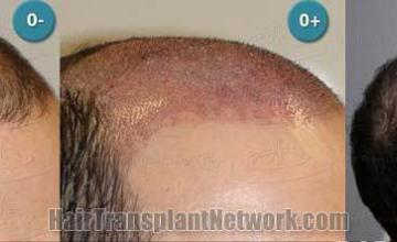 Hair restoration procedure before and after results