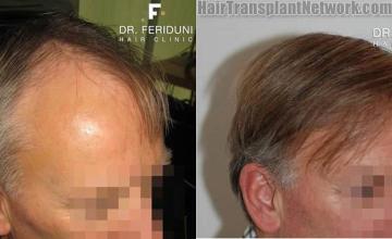 Hair restoration procedure results