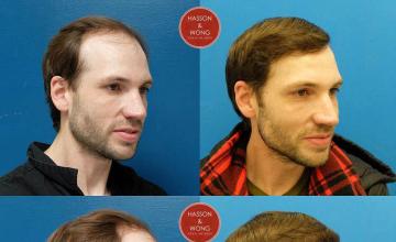 Hair transplantation surgery before and after images