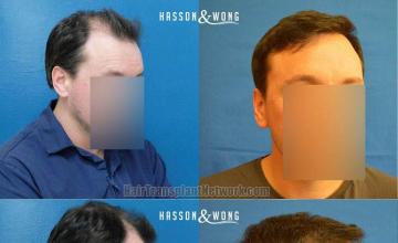 Hair transplantation surgery before and after images