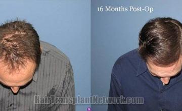 Top view images before and after hair transplant 