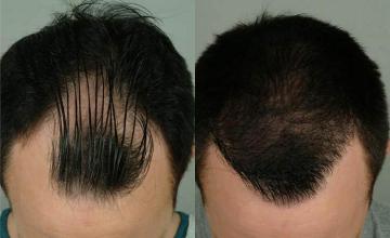 Before and after hair transplant procedure images