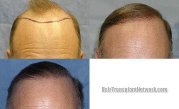 Hair restoration procedure before and after results