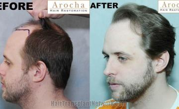 Hair transplantation surgery before and after images