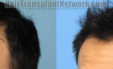 Hair transplantation surgery before and after images