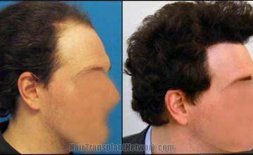 Hair restoration procedure before and after pictures