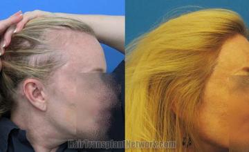 Hair transplantation surgery before and after photos