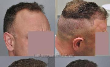 Hair transplantation surgery before and after images