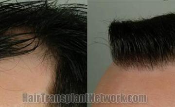 Hair transplantation surgery before and after photos